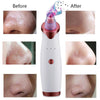 BlackVac™ Blackhead & Pore Vacuum